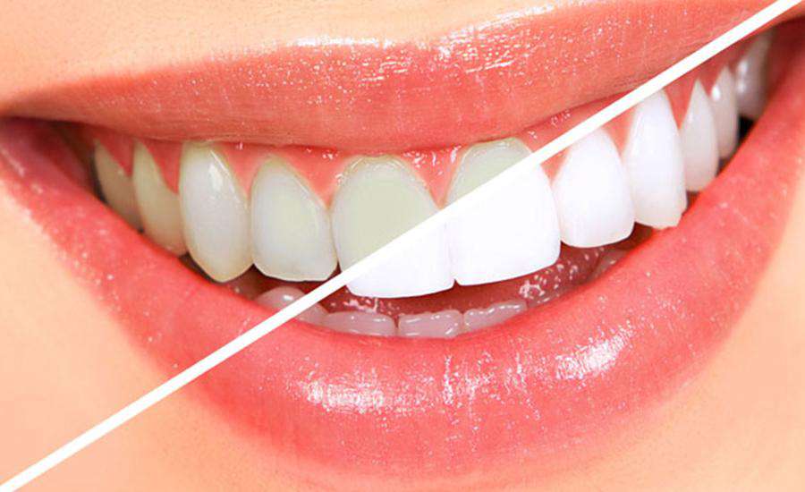 Diş Beyazlatma Yöntemleri Nelerdir?