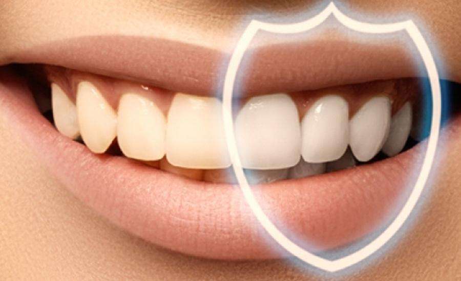 Diş Beyazlatma İşlemi Nedir?